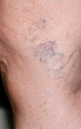 Sclerotherapy before 370424