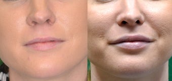 Restylane Filler in Lips before 1306453