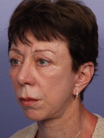Eyelid Surgery after 280831