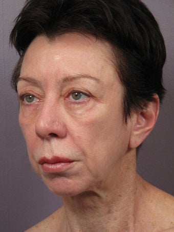Eyelid Surgery before 280831