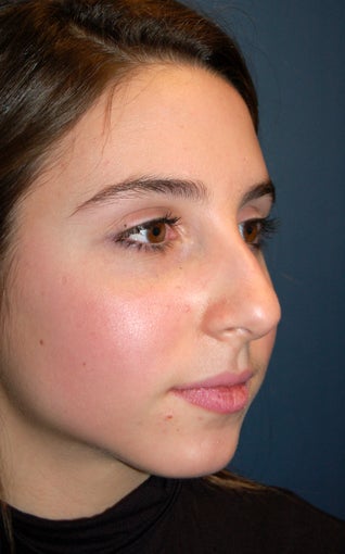 Nose Surgery 928624