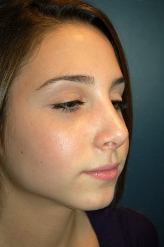 Nose Surgery 928624
