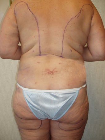 Liposuction of Buttocks and Hips after 55476