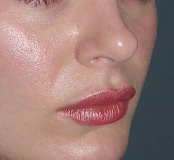 Lip Augmentation after 361670