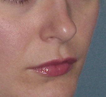 Lip Augmentation before 361670