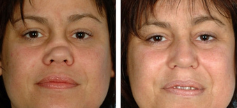 Functional Rhinoplasty before 1208300