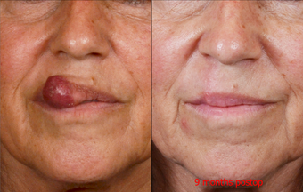 65-year-old woman with large lip lesion treated by surgical excision and repair before 663969