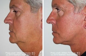 Facelift with dermabrasion before 91396