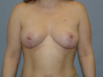 Mastopexy after 99654