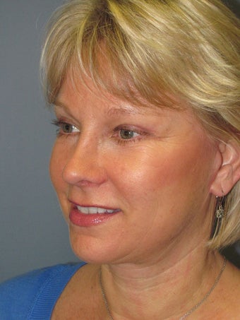 Blue Peel 954425