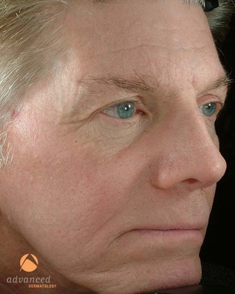 Male Treated with BOTOX® Cosmetic, Perlane® & Sculptra® before 1047016