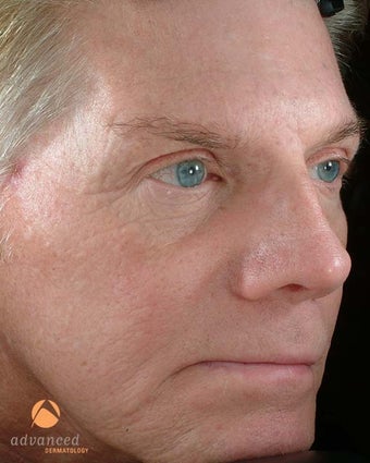 Male Treated with BOTOX® Cosmetic, Perlane® & Sculptra® after 1047016