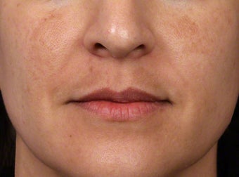 Brightening Facials for Melasma before 539894