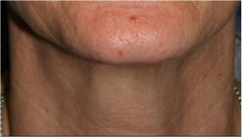 55 Year old female with aging neck due to neck bands. She doesn't want a surgical neck lift after 766012