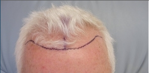Hair Transplant before 387807