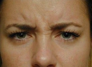 Botox for Frown Lines before 968632