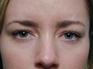 Botox for Frown Lines after 968632