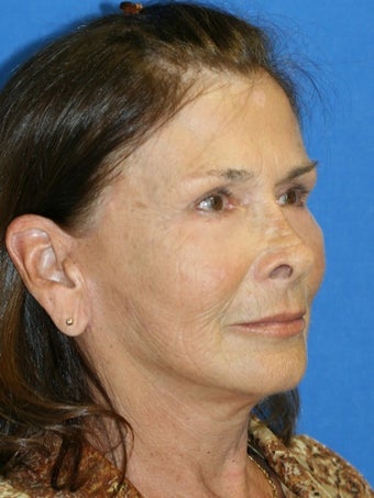 Facelift after 264049