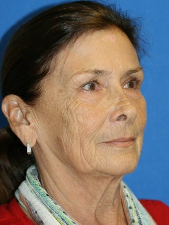Facelift before 264049
