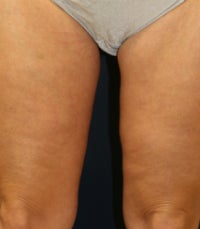 Thighplasty after 675703