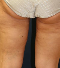 Thighplasty 675703