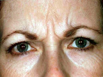Botox before 748927