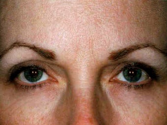 Botox after 748927