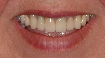 Porcelain Veneers and Dental Crowns after 529035