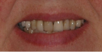 Porcelain Veneers and Dental Crowns before 529035
