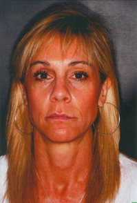 Laser Skin Resurfacing after 913174