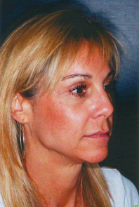 Laser Skin Resurfacing 913174