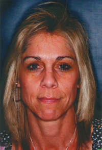 Laser Skin Resurfacing before 913174