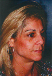 Laser Skin Resurfacing 913174