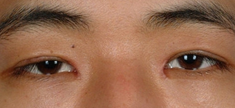 Asian Eyelid Surgery after 1208019