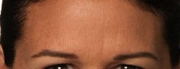 Close up of Botox relaxing frown lines in my female patient after 1328548
