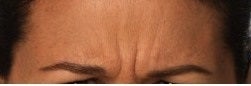 Close up of Botox relaxing frown lines in my female patient before 1328548