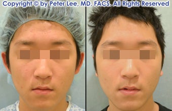 Ear Surgery (Otoplasty) before 1102768