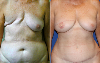 DIEP - Breast Reconstruction before 331098