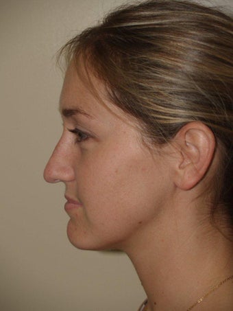 Rhinoplasty before 214750