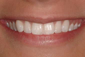 Porcelain Veneers after 207711