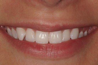 Porcelain Veneers before 207711
