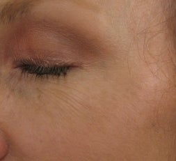 Crows feet after a single 1540 Lux Fractional Laser Treatment after 52900