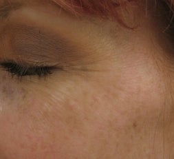 Crows feet after a single 1540 Lux Fractional Laser Treatment before 52900