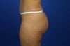 51 Year Old Patient Treated for Buttock Drooping & Flatness 774664
