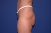 51 Year Old Patient Treated for Buttock Drooping & Flatness 774664