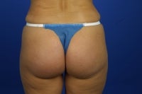 51 Year Old Patient Treated for Buttock Drooping & Flatness after 774664