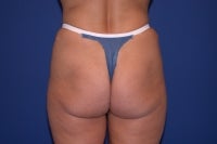 51 Year Old Patient Treated for Buttock Drooping & Flatness before 774664