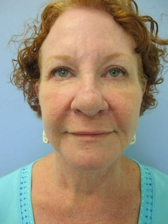 Woman, facelift and BOTOX procedure after 825431