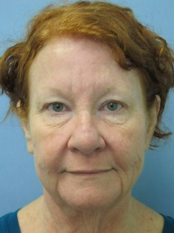 Woman, facelift and BOTOX procedure before 825431