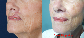 65-year-old with poor lip scarring repaired with local flap reconstruction after 672296